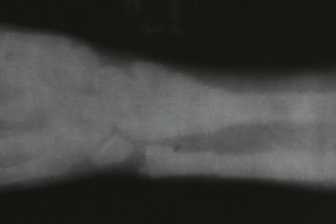 xray image of Eddie McCarthy's broken wrist