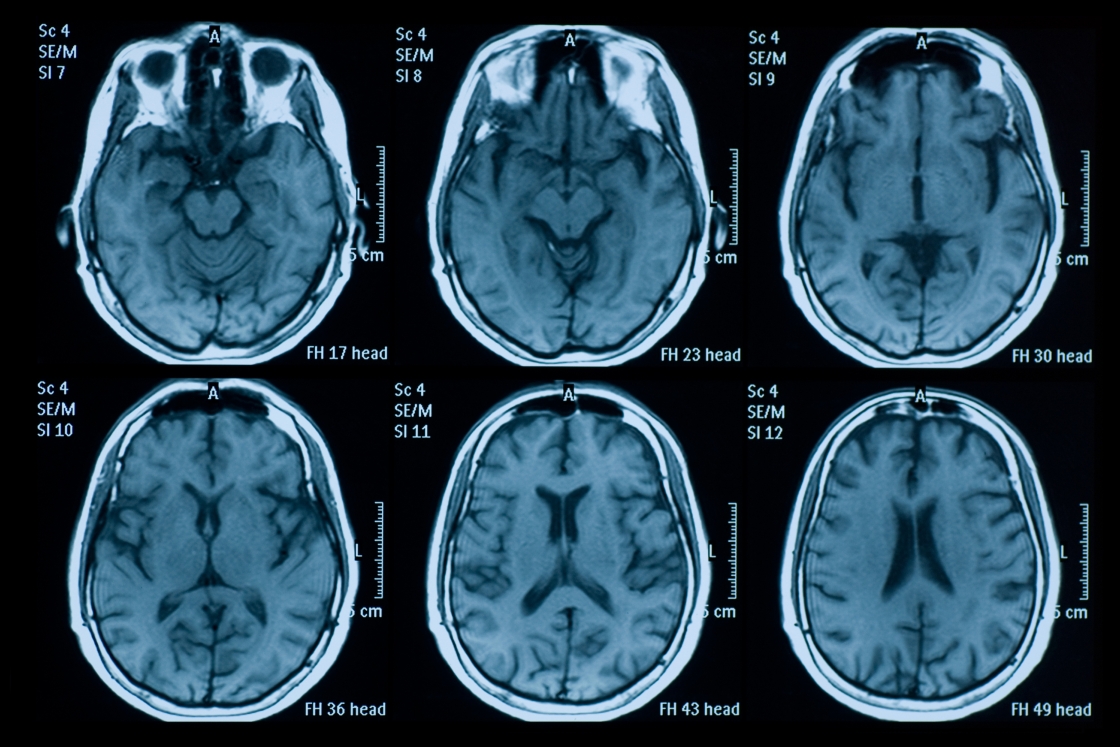 MRI scan of a brain