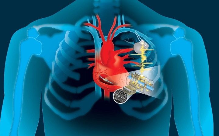 pacemakers implanted graphic