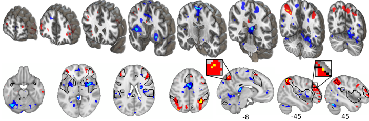 fMRI activity during pain is reduced in the areas shown in blue. Many of these are involved in constructing the experience of pain. Activity is increased in the areas shown in red and yellow, which involve the control of cognition and memory. (Image provi